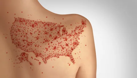 Measles infections send 1 in 5 people to the hospital.